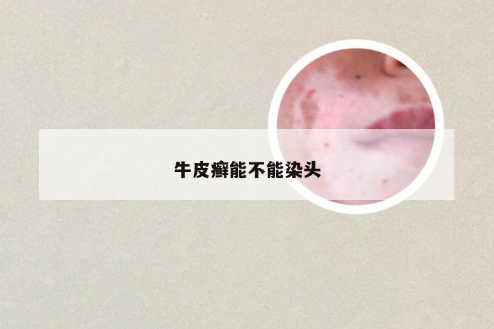 牛皮癣能不能染头