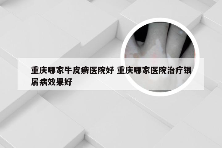 重庆哪家牛皮癣医院好 重庆哪家医院治疗银屑病效果好