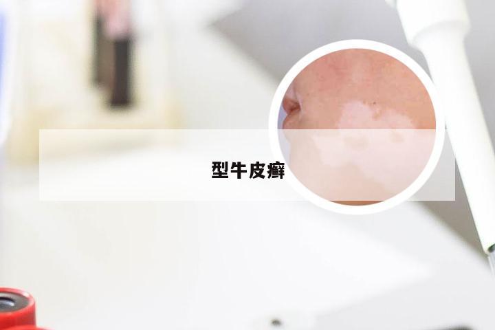 型牛皮癣