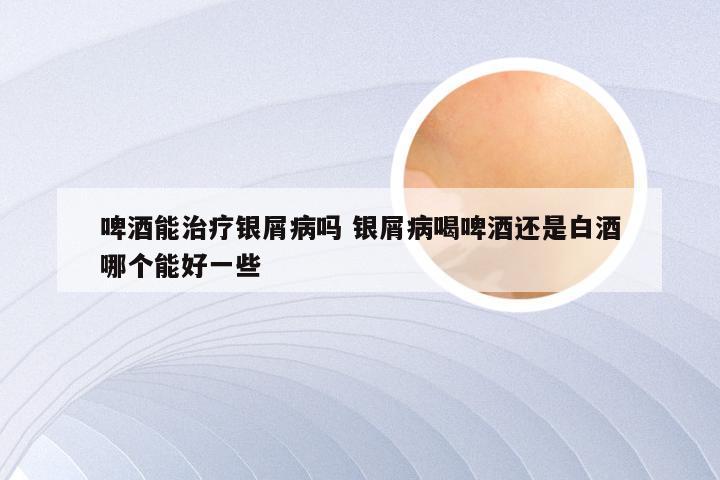 啤酒能治疗银屑病吗 银屑病喝啤酒还是白酒哪个能好一些