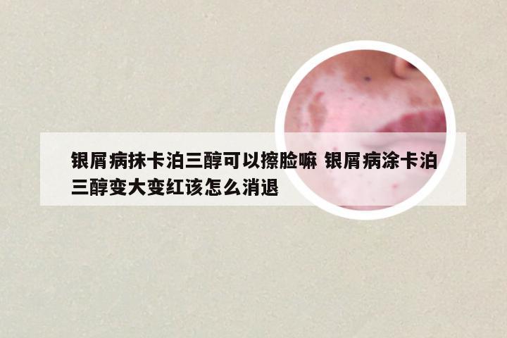 银屑病抹卡泊三醇可以擦脸嘛 银屑病涂卡泊三醇变大变红该怎么消退