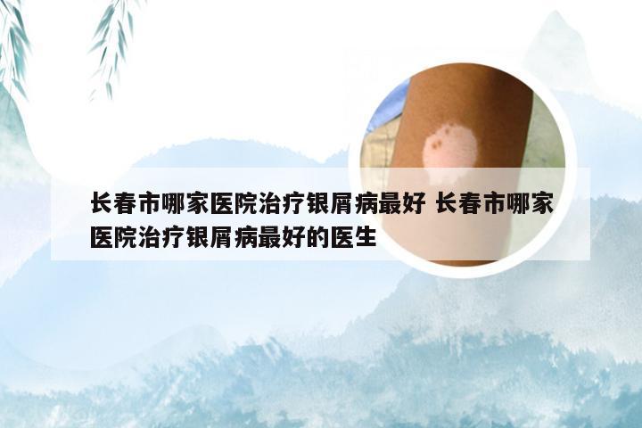 长春市哪家医院治疗银屑病最好 长春市哪家医院治疗银屑病最好的医生