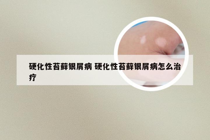 硬化性苔藓银屑病 硬化性苔藓银屑病怎么治疗