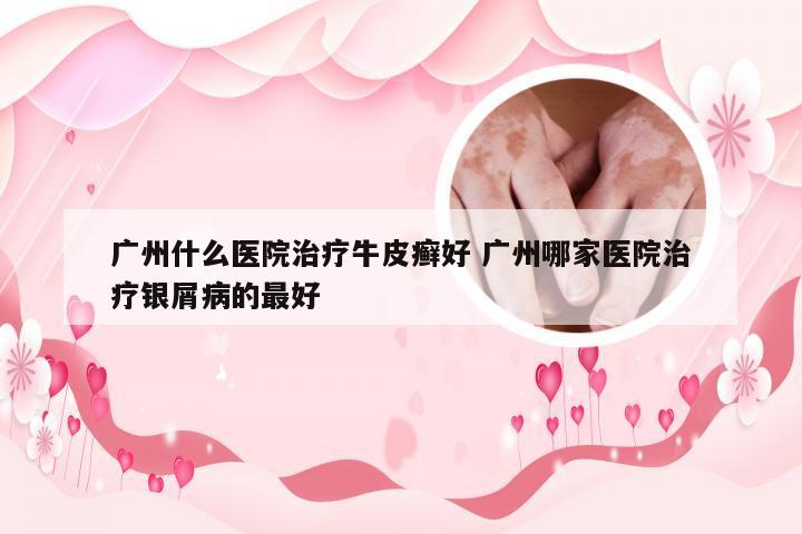 广州什么医院治疗牛皮癣好 广州哪家医院治疗银屑病的最好