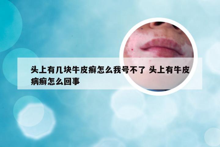 头上有几块牛皮癣怎么我号不了 头上有牛皮病癣怎么回事