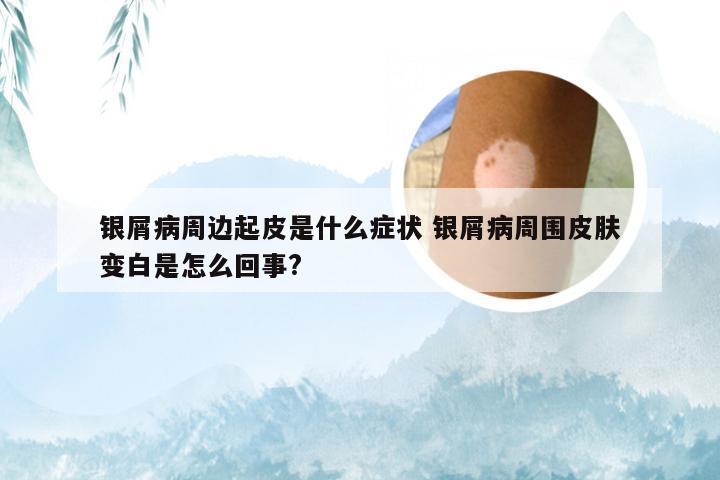 银屑病周边起皮是什么症状 银屑病周围皮肤变白是怎么回事?