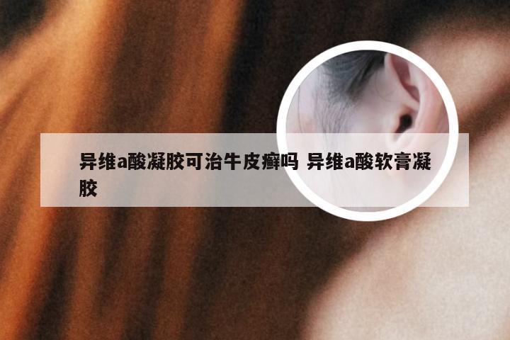 异维a酸凝胶可治牛皮癣吗 异维a酸软膏凝胶