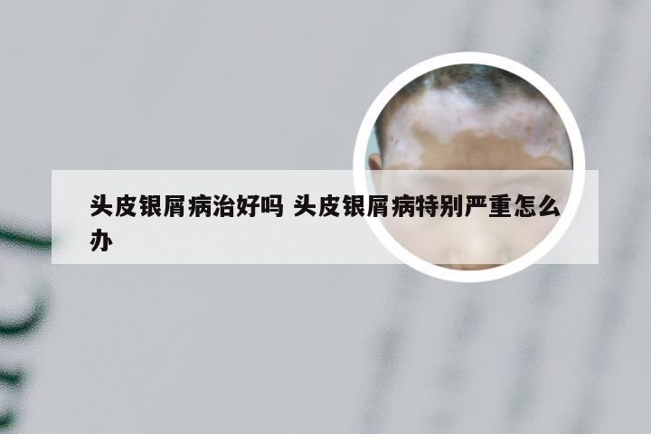 头皮银屑病治好吗 头皮银屑病特别严重怎么办