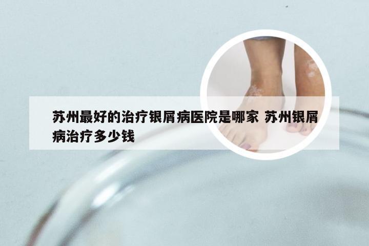 苏州最好的治疗银屑病医院是哪家 苏州银屑病治疗多少钱