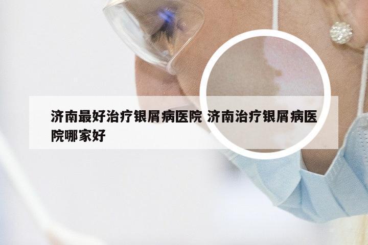 济南最好治疗银屑病医院 济南治疗银屑病医院哪家好