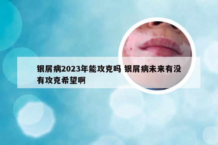 银屑病2023年能攻克吗 银屑病未来有没有攻克希望啊