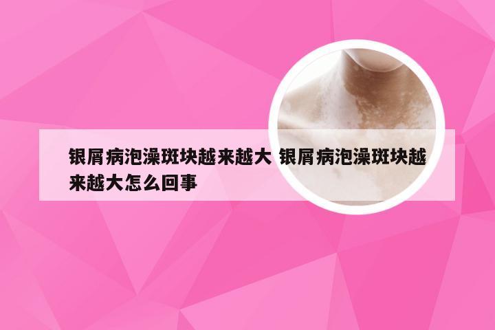 银屑病泡澡斑块越来越大 银屑病泡澡斑块越来越大怎么回事