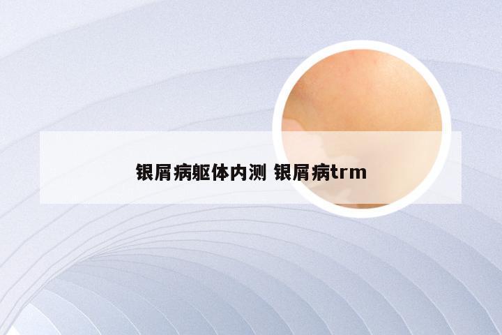 银屑病躯体内测 银屑病trm