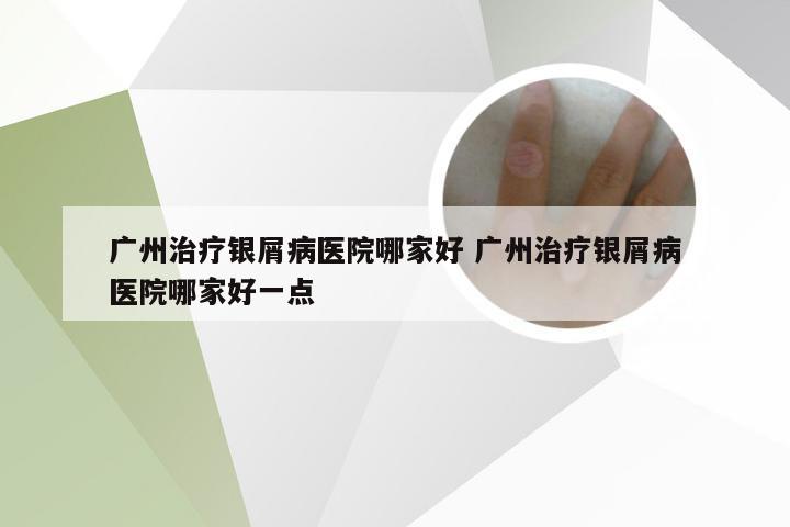 广州治疗银屑病医院哪家好 广州治疗银屑病医院哪家好一点