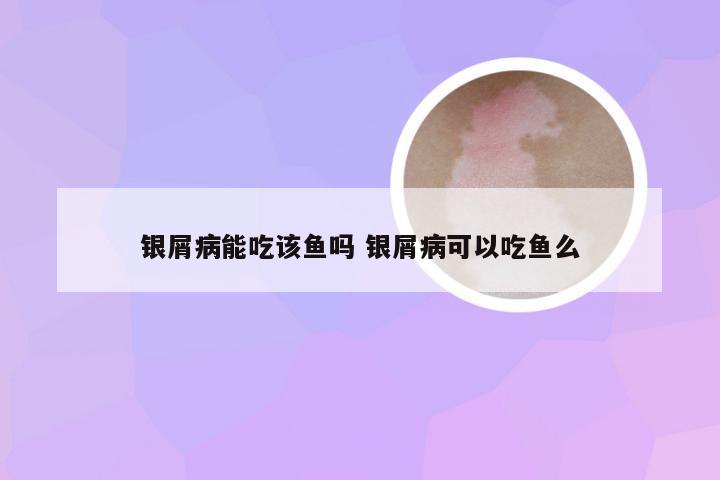 银屑病能吃该鱼吗 银屑病可以吃鱼么