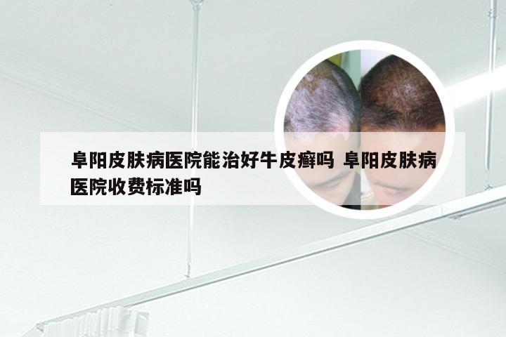 阜阳皮肤病医院能治好牛皮癣吗 阜阳皮肤病医院收费标准吗