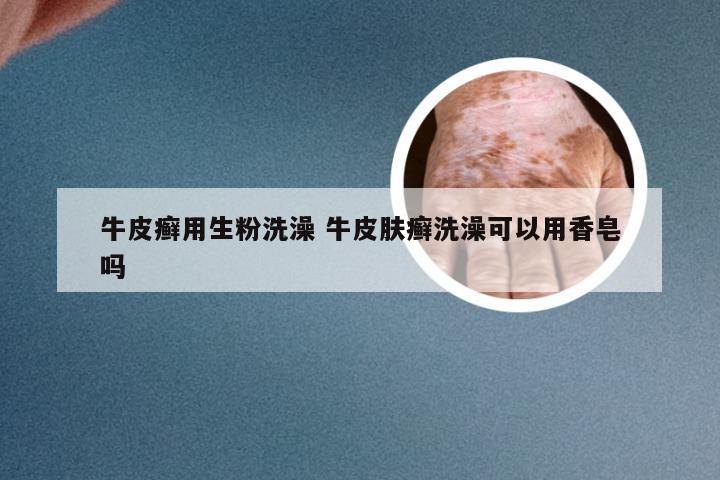 牛皮癣用生粉洗澡 牛皮肤癣洗澡可以用香皂吗