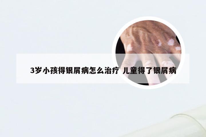 3岁小孩得银屑病怎么治疗 儿童得了银屑病