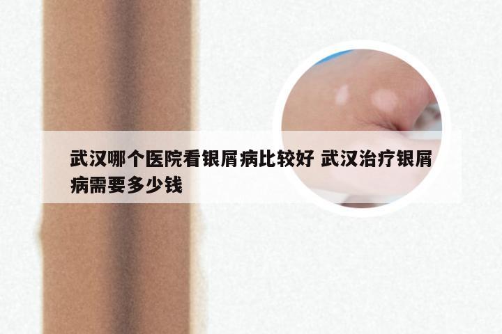 武汉哪个医院看银屑病比较好 武汉治疗银屑病需要多少钱