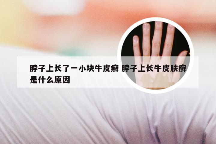 脖子上长了一小块牛皮癣 脖子上长牛皮肤癣是什么原因