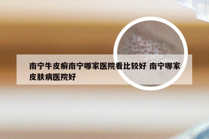 南宁牛皮癣南宁哪家医院看比较好 南宁哪家皮肤病医院好