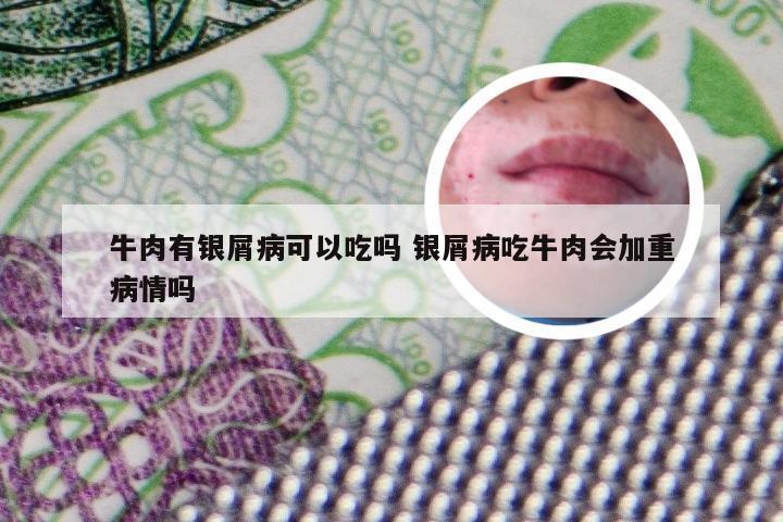 牛肉有银屑病可以吃吗 银屑病吃牛肉会加重病情吗
