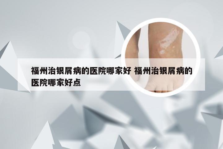 福州治银屑病的医院哪家好 福州治银屑病的医院哪家好点