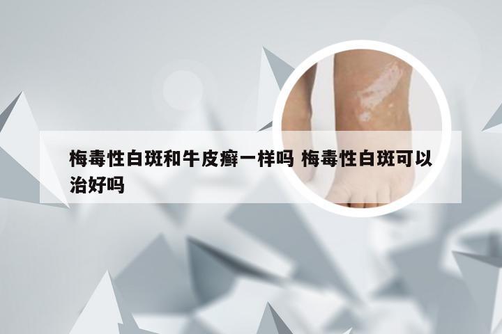梅毒性白斑和牛皮癣一样吗 梅毒性白斑可以治好吗