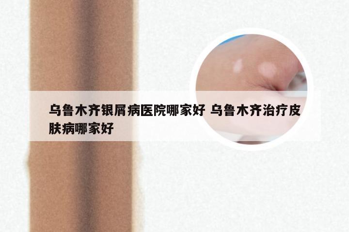 乌鲁木齐银屑病医院哪家好 乌鲁木齐治疗皮肤病哪家好
