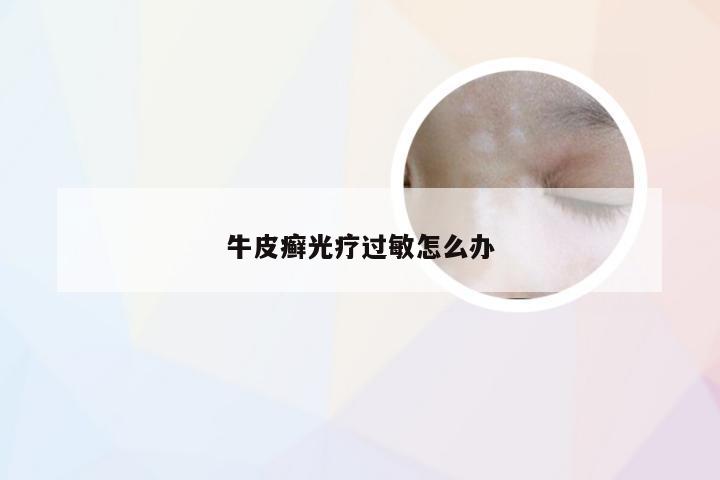 牛皮癣光疗过敏怎么办