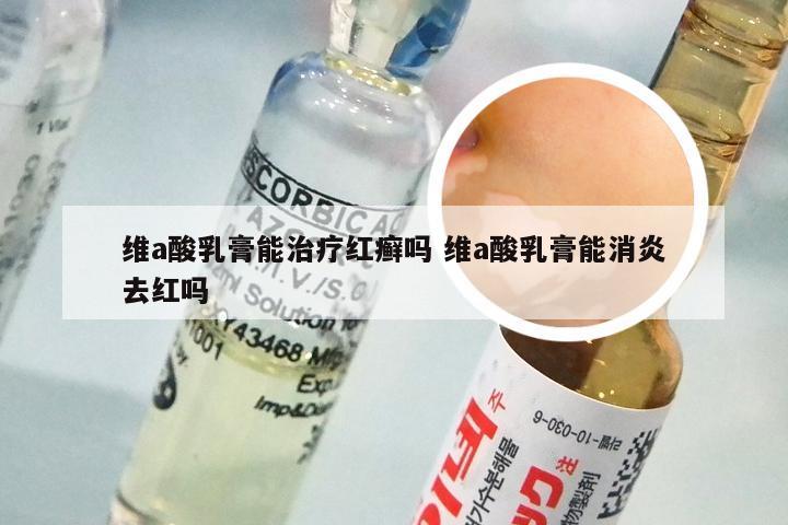 维a酸乳膏能治疗红癣吗 维a酸乳膏能消炎去红吗