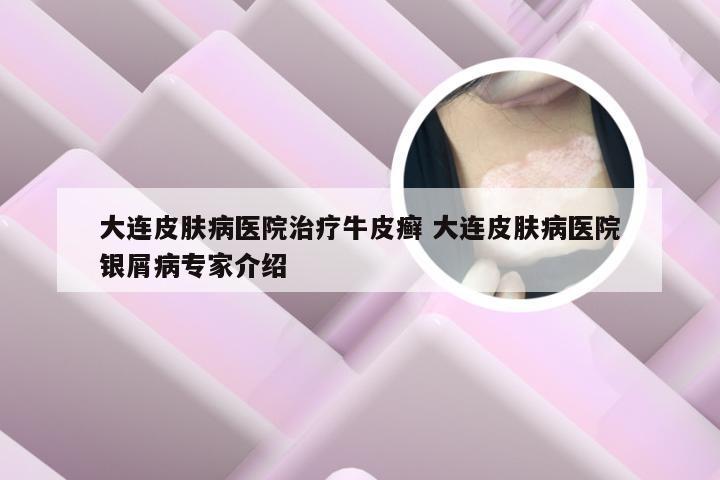 大连皮肤病医院治疗牛皮癣 大连皮肤病医院银屑病专家介绍
