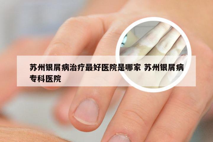 苏州银屑病治疗最好医院是哪家 苏州银屑病专科医院