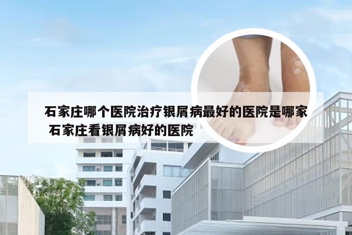 石家庄哪个医院治疗银屑病最好的医院是哪家 石家庄看银屑病好的医院