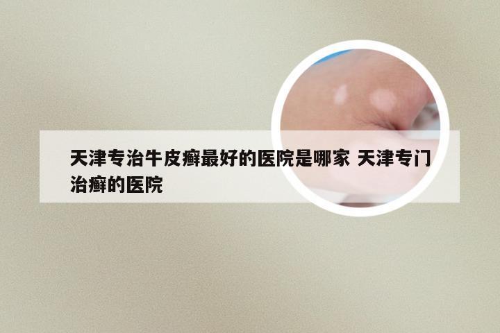 天津专治牛皮癣最好的医院是哪家 天津专门治癣的医院