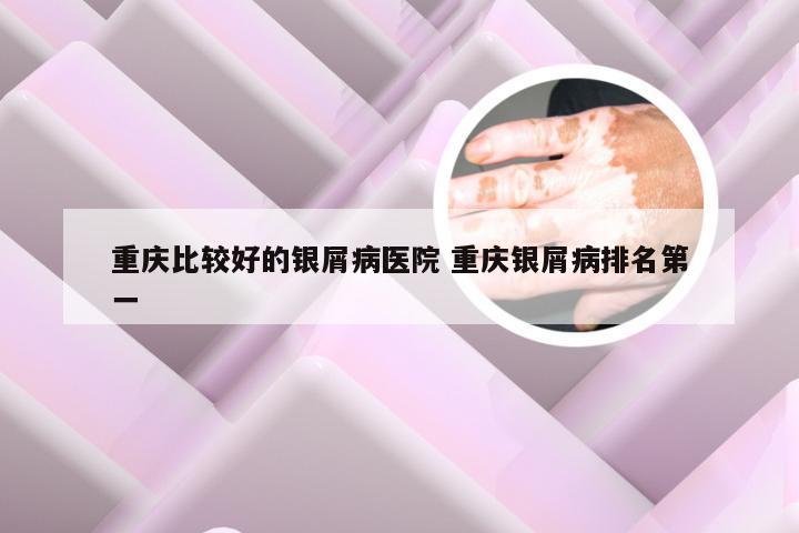 重庆比较好的银屑病医院 重庆银屑病排名第一