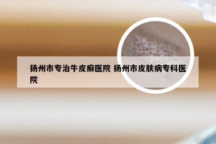 扬州市专治牛皮癣医院 扬州市皮肤病专科医院