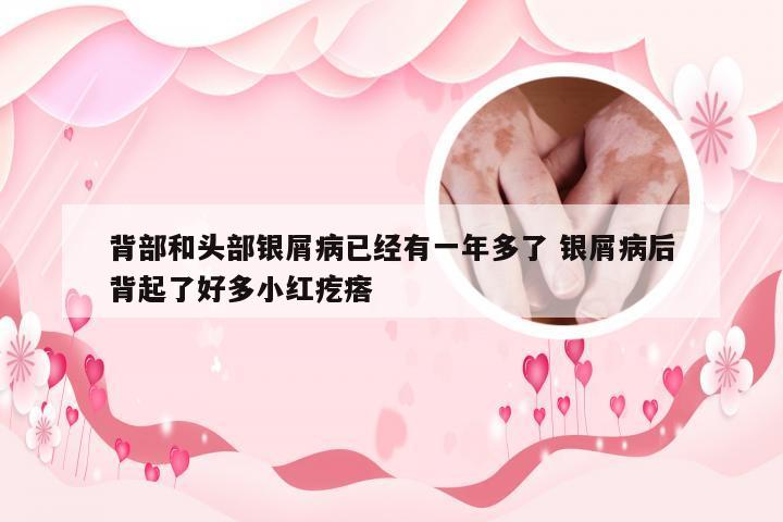 背部和头部银屑病已经有一年多了 银屑病后背起了好多小红疙瘩