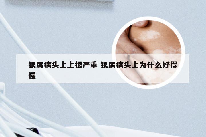 银屑病头上上很严重 银屑病头上为什么好得慢