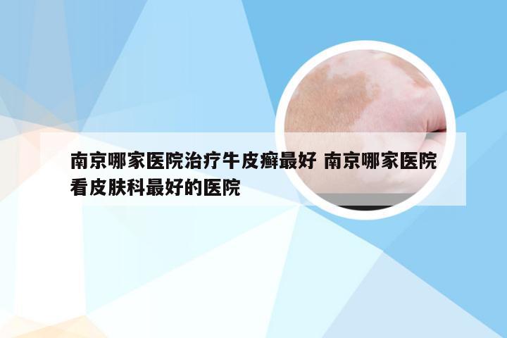 南京哪家医院治疗牛皮癣最好 南京哪家医院看皮肤科最好的医院