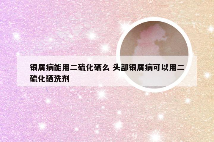 银屑病能用二硫化硒么 头部银屑病可以用二硫化硒洗剂