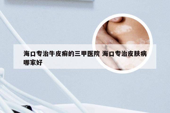 海口专治牛皮癣的三甲医院 海口专治皮肤病哪家好
