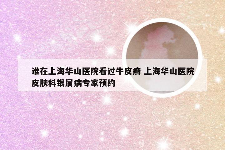 谁在上海华山医院看过牛皮癣 上海华山医院皮肤科银屑病专家预约