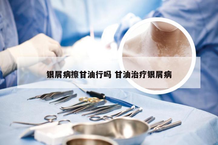 银屑病擦甘油行吗 甘油治疗银屑病