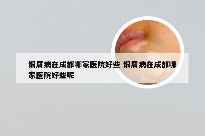 银屑病在成都哪家医院好些 银屑病在成都哪家医院好些呢
