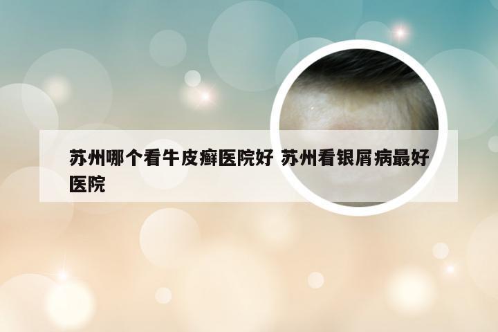 苏州哪个看牛皮癣医院好 苏州看银屑病最好医院