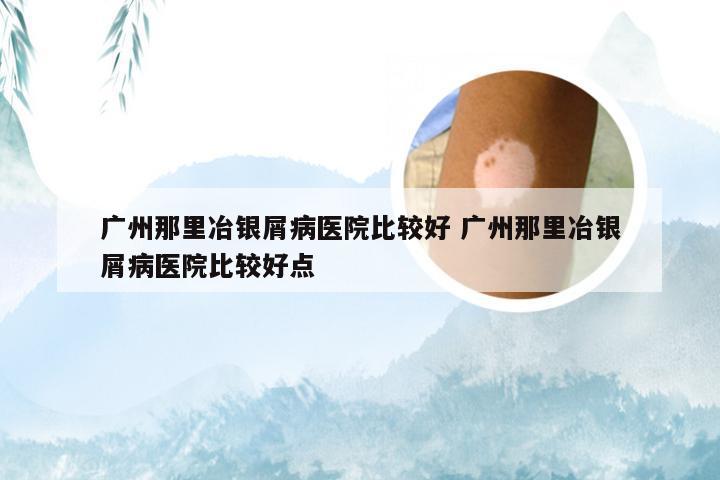 广州那里冶银屑病医院比较好 广州那里冶银屑病医院比较好点