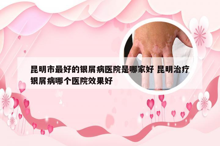 昆明市最好的银屑病医院是哪家好 昆明治疗银屑病哪个医院效果好