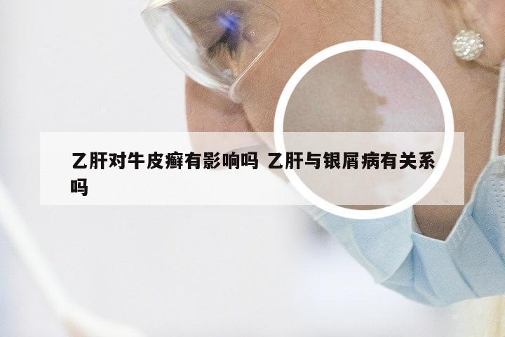 乙肝对牛皮癣有影响吗 乙肝与银屑病有关系吗