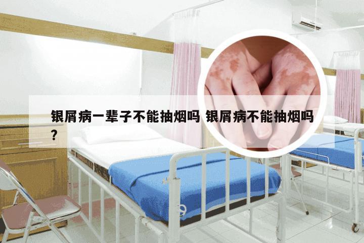 银屑病一辈子不能抽烟吗 银屑病不能抽烟吗?